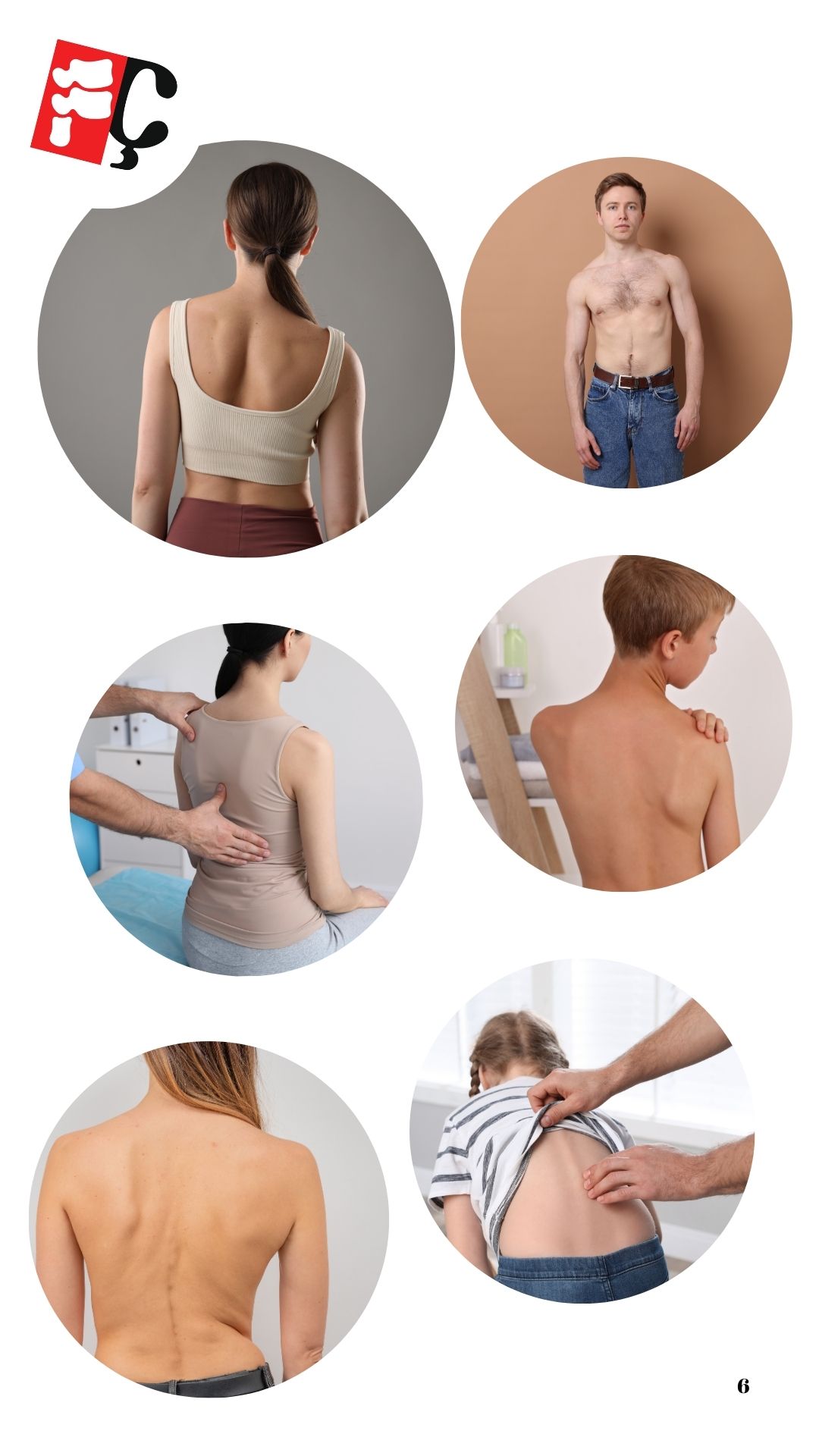 Skolyoz (Schroth Terapisi)