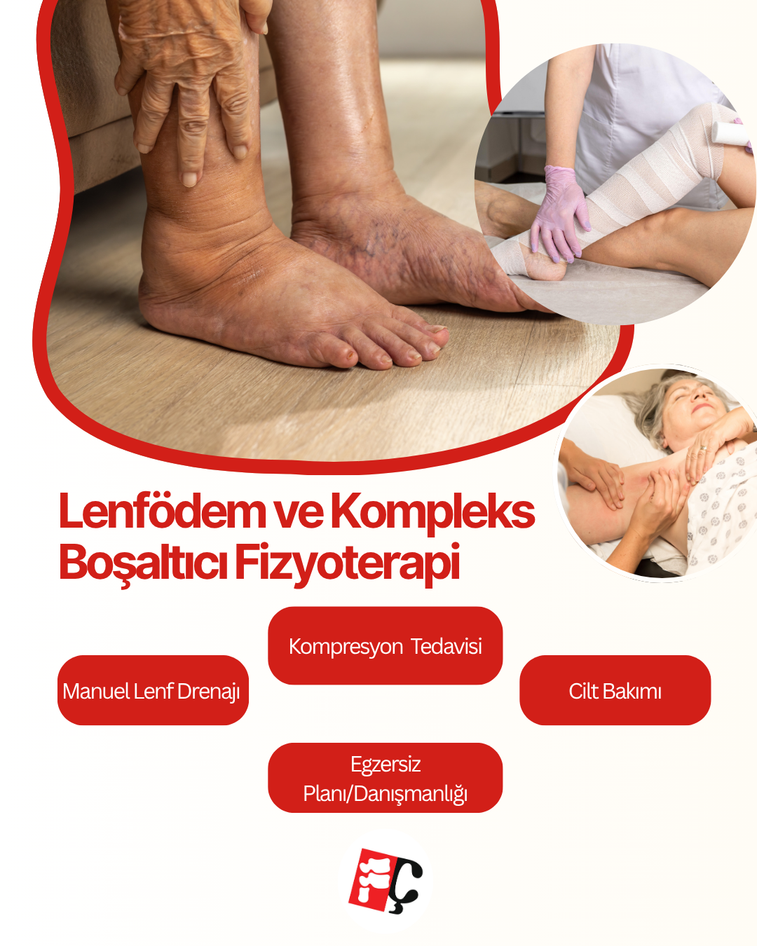 Lenfödem ve Kompleks Boşaltıcı Terapi